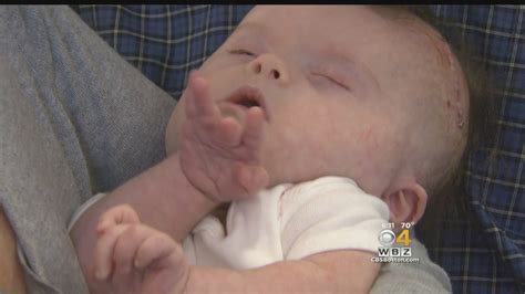 Boston doctors performed brain surgery on a baby before she was born and now she’s thriving